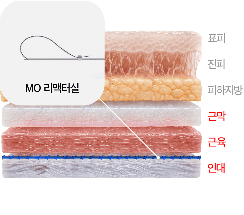 MO 线雕提升疗程层剖面图