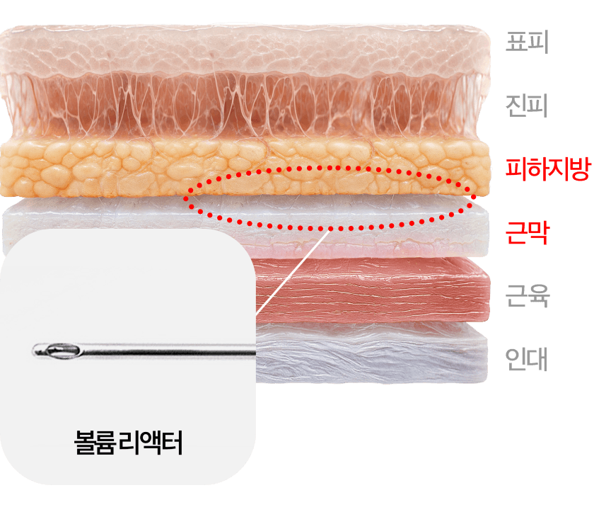 专利丰盈针注入层剖面图