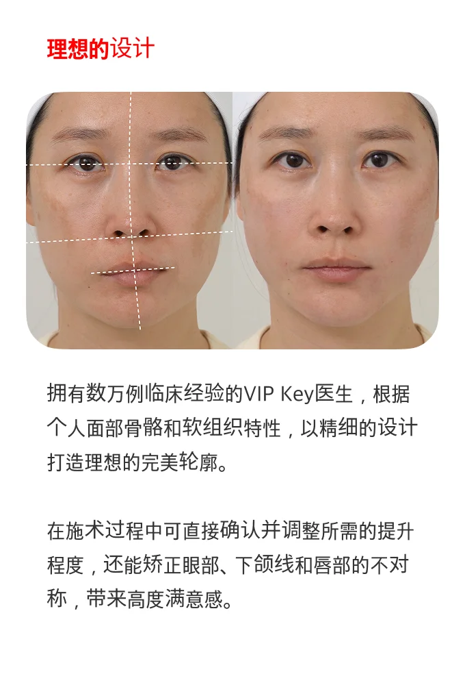 MO 线雕提升疗程部位