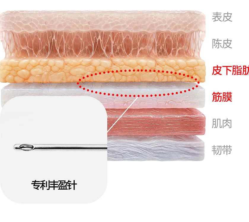 专利丰盈针注入层剖面图