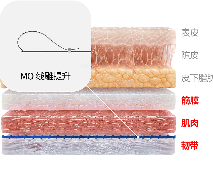 MO 线雕提升疗程层剖面图